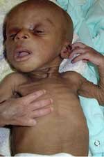 Starving baby in Africa